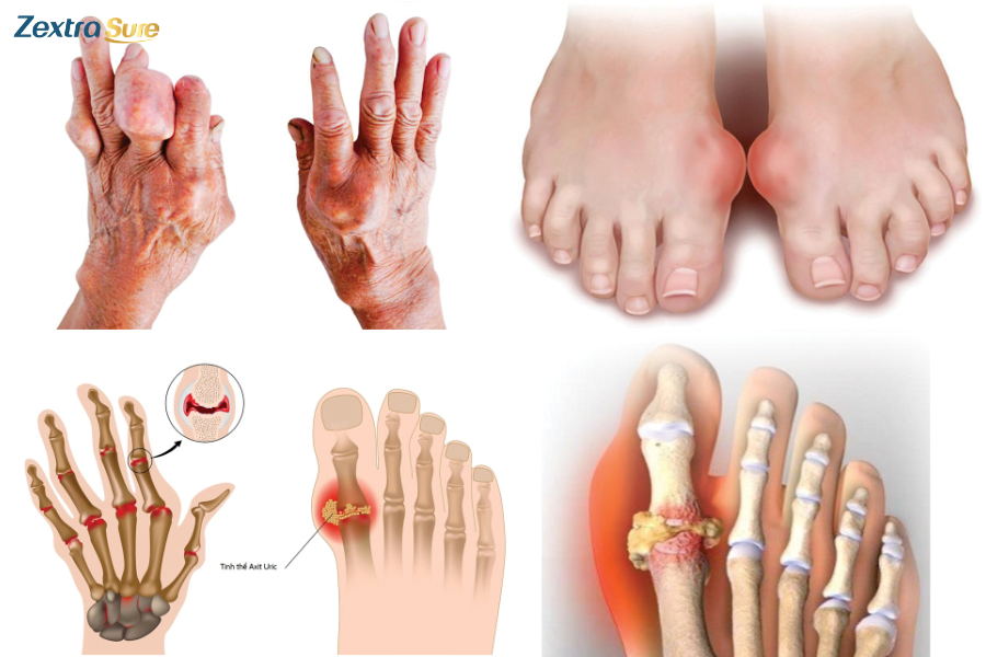 Gout is caused by uric acid crystals triggering joint inflammation